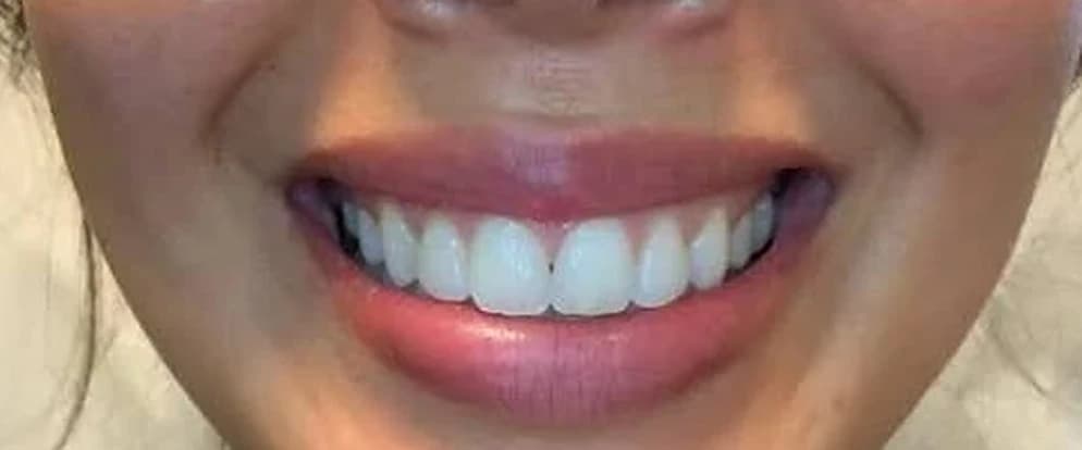 Lip Flip, after