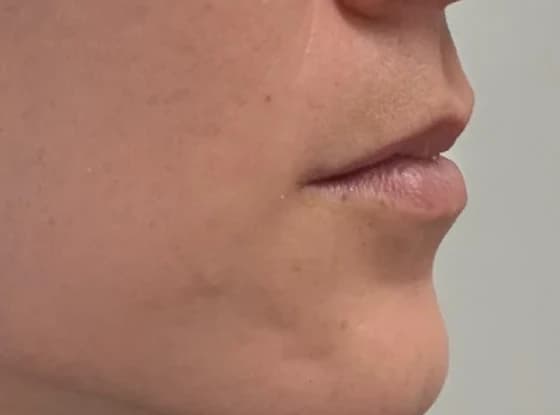 Lower Face Botox (off-label), after