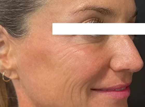 Xeomin, before