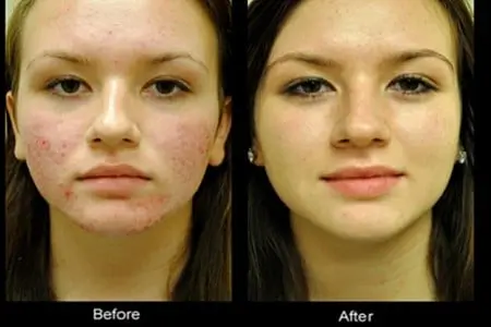 acne treatment lady before and after pictures
