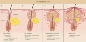Pathogenesis of Acne treatment photo