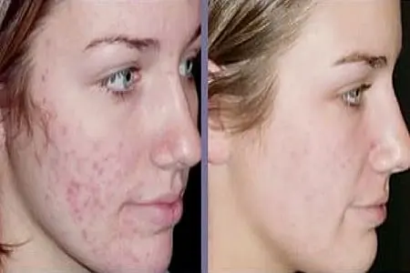 Acne scars treatment before and after photo
