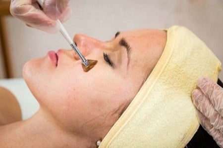 chemical peels