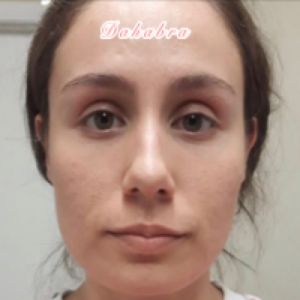 acne treatment lady after pic