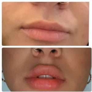 Lip Augmentation in West Palm Beach: Transform Your Smile Today!