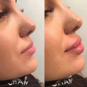 Lip Injections in West Palm Beach: The Ultimate Guide for Your Perfect Pout