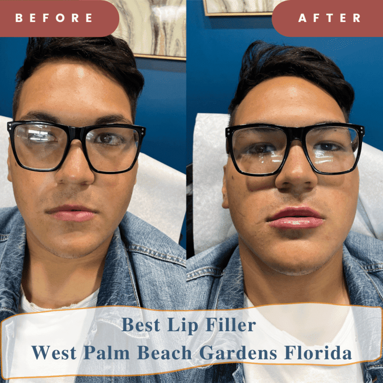 Lip Injections in West Palm Beach: The Ultimate Guide for Your Perfect Pout