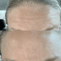 Before and After photo of Botox in west palm beach florida Fl