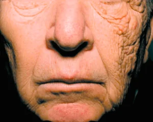 wrinkles