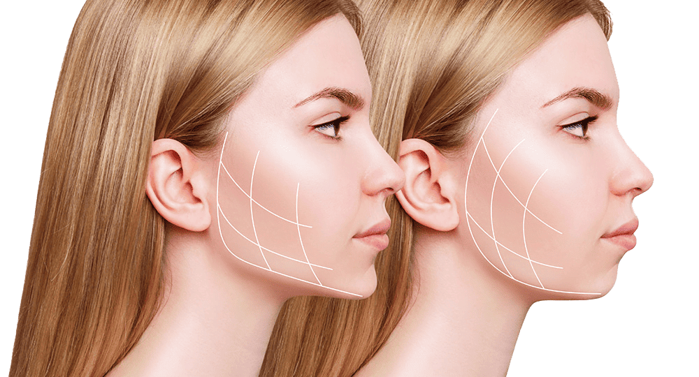 chin injections virginia diagram