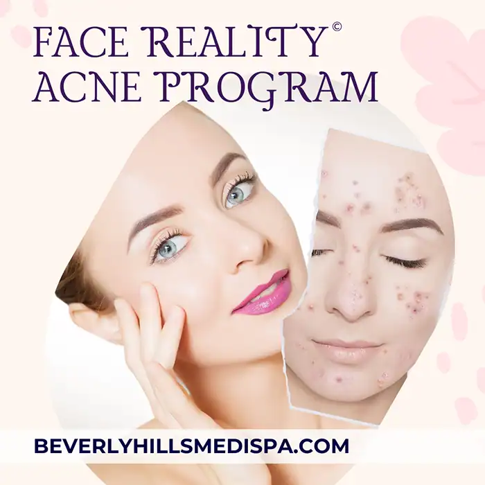 Face Reality acne program price in Palm Beach, Florida Face Reality acne program price in Palm Beach, Florida