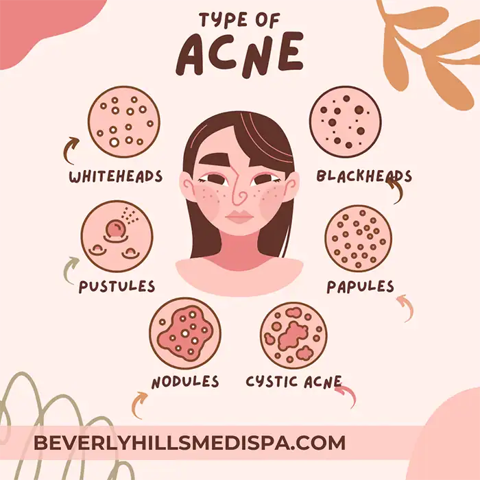 Laser acne treatment price in Palm Beach, Florida Laser acne treatment price in Palm Beach, Florida