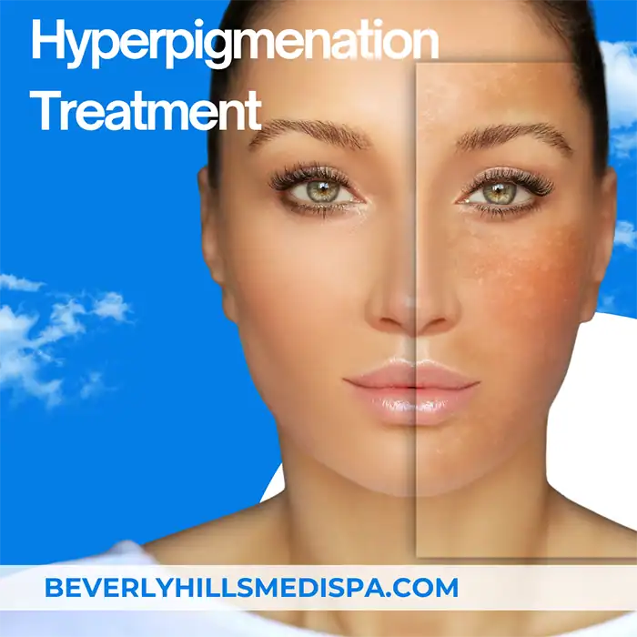 Hyperpigmentation treatment price in Palm Beach, Florida Hyperpigmentation treatment price in Palm Beach, Florida