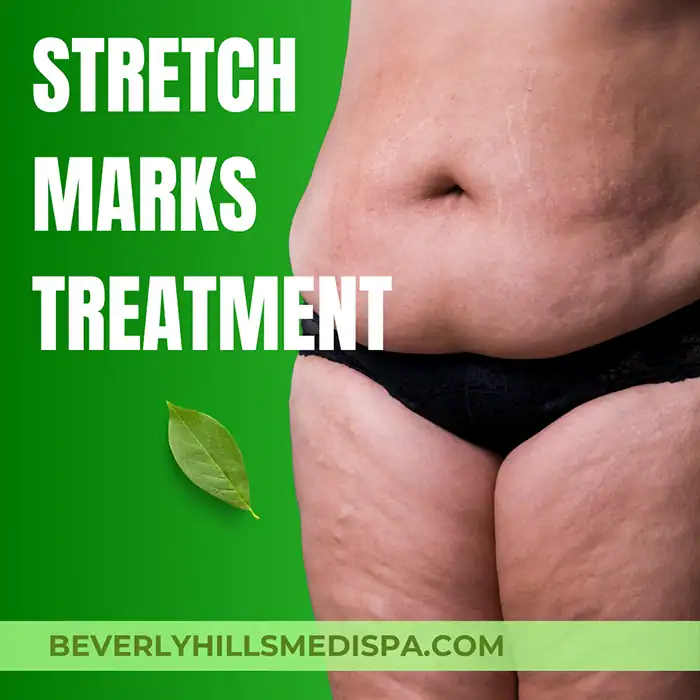 Stretch marks treatment price in Palm Beach, Florida Stretch marks treatment price in Palm Beach, Florida