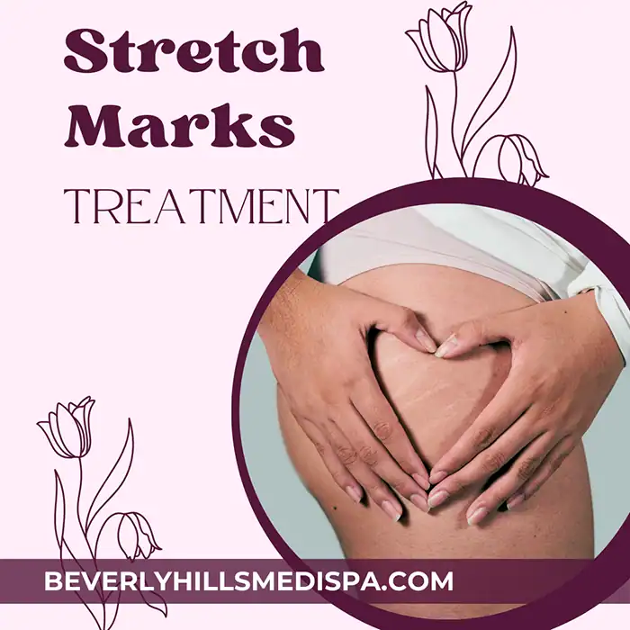 The best stretch mark treatments in Palm Beach, Florida