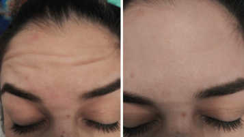 Before and After photo of Botox in west palm beach florida Fl